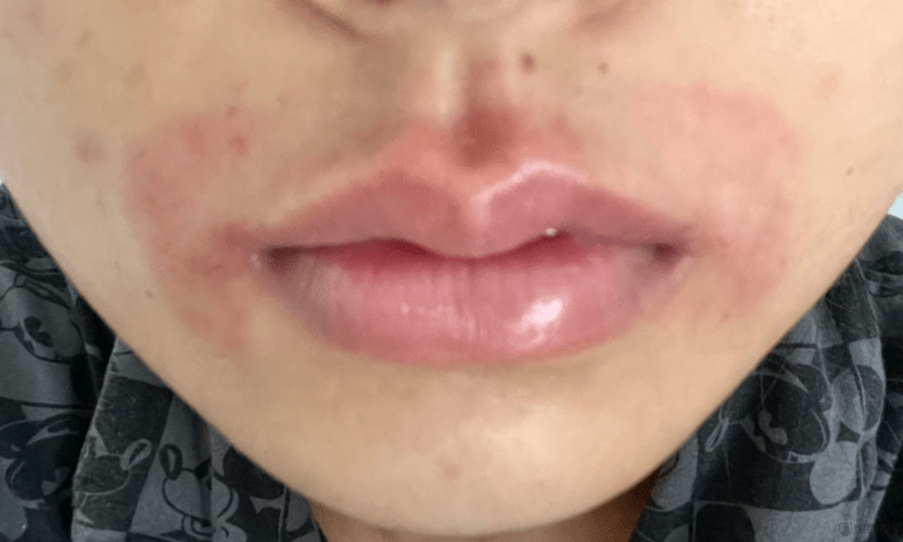 消费者投诉:宫芙脱毛膏使用后出现红肿刺痛_donews_平台_直播间