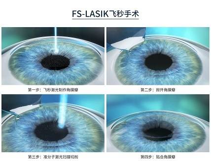 全飞秒和半飞秒哪个更好,重庆全飞秒手术哪家强,全飞秒价格表_角膜