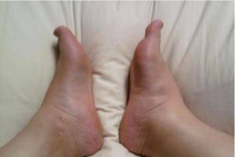 【孕妇脚肿】孕妇脚肿怎么办_孕妇脚肿是什么原因