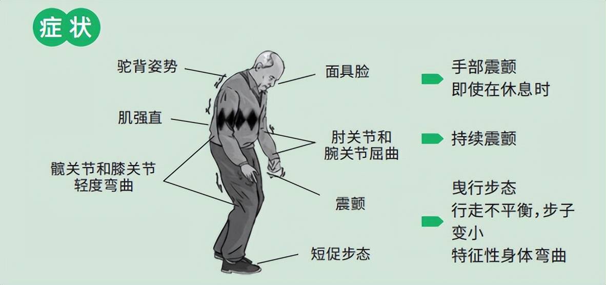 帕金森病最常见的症状有,静止时手,头或嘴不自主地震颤,颈项强直,动作