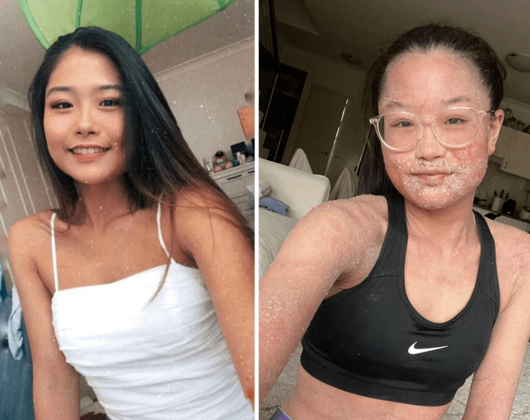 澳洲亚裔美女停皮肤病药后毁容美丽皮肤变象皮