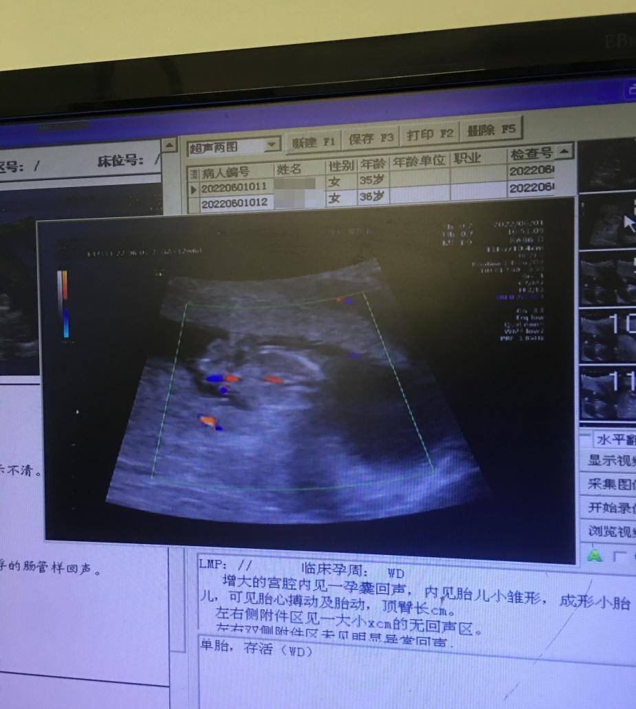 武汉一准妈妈检查出胎儿先天性"腹裂" 医生:切莫忽略产前检查_王娟_李