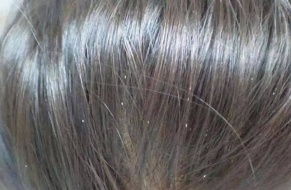原创30年前农村人头发的虱子为何现在人没有被洗发水消灭了吗