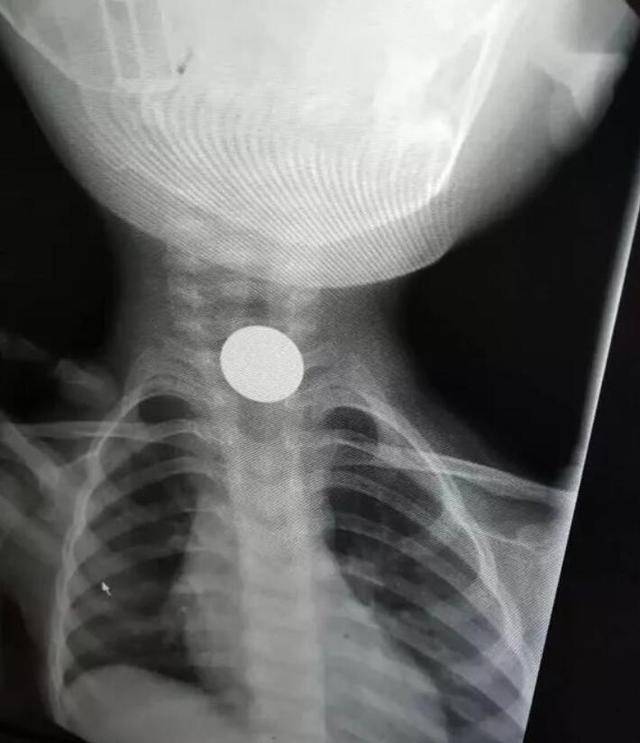 把樱桃肉卡在了喉咙里,孩子难受地哭出来,奶奶也慌了手脚,赶紧用手抠