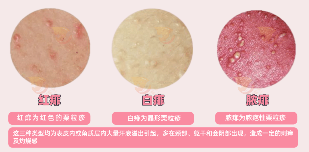 发生症状可外用炉甘石洗剂局部涂抹治疗.