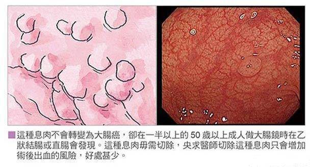 根據世界衛生組織的分類,指的是有較高風險轉變為癌症的腺瘤 ,也就是