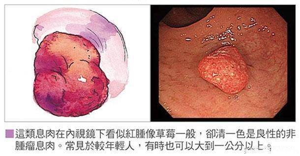 最常见的息肉分哪几种类型早知道早筛查早治疗