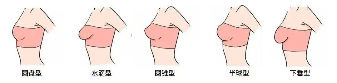 乳房呈圆锥形图片