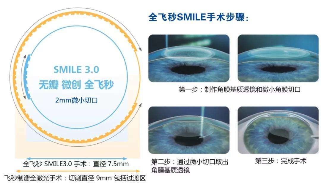 上海做全飞秒哪家公立医院好？全飞秒医生排名参考（第一试管网）