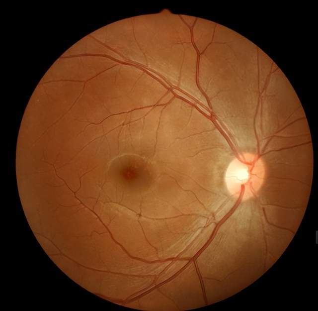 新生血管生长,玻璃体大量出血或增殖性玻璃体视网膜病变及牵引性
