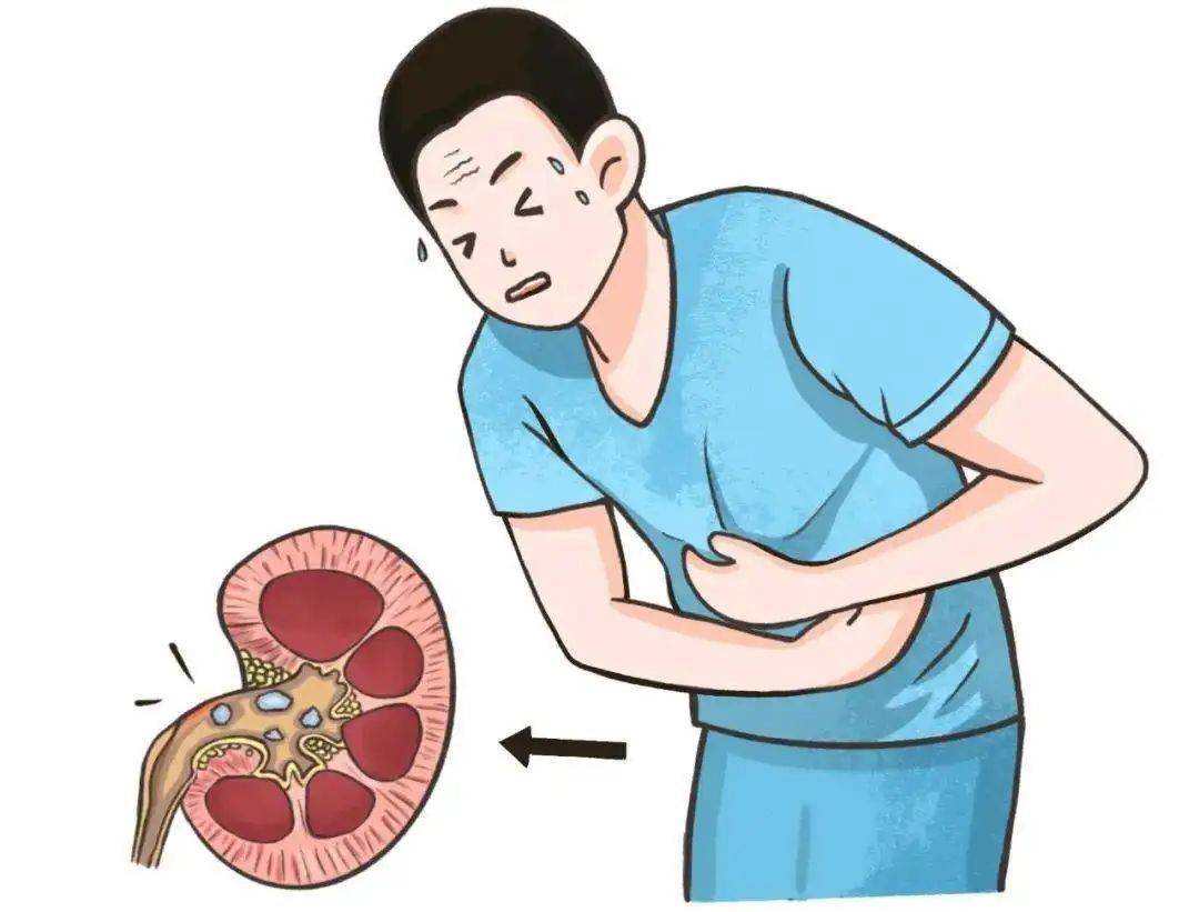 50大叔结石拖成肾癌只因做错了这件事