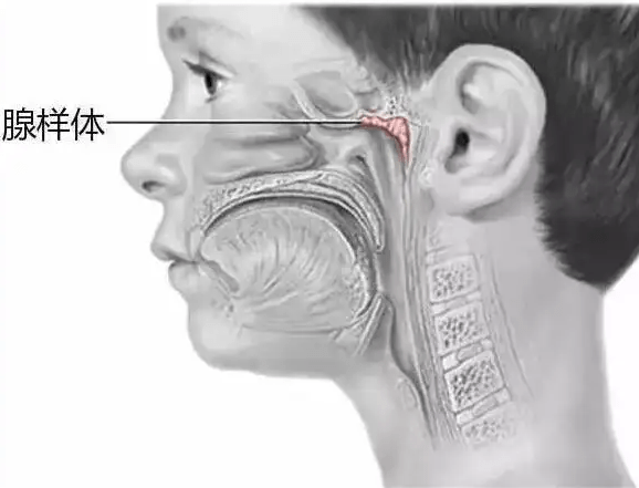 等到孩子病好了,腺样体通常就会逐渐恢复原貌.