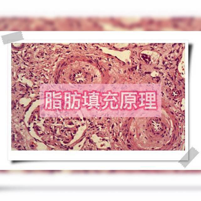 术后早期可能发生疼痛,水肿,瘀青,血肿,感染,脂肪聚集,脂肪液化,囊性