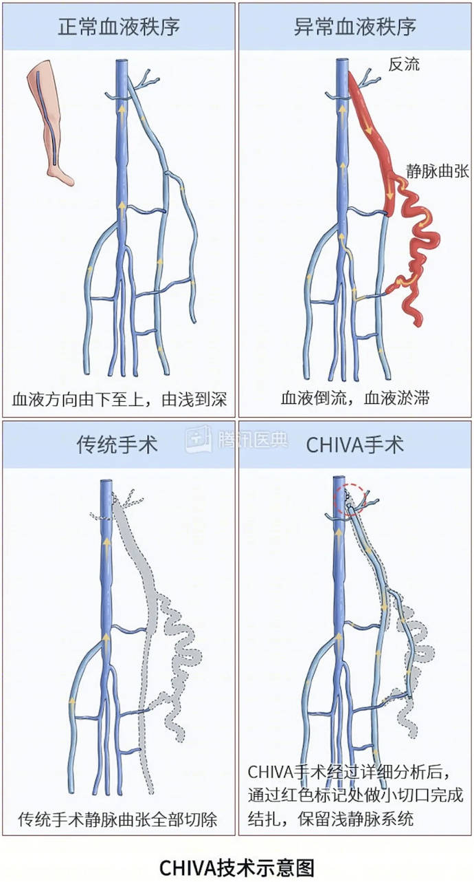 张张强医生集团的chiva治疗技术保留了完整的静脉回流网络,几乎没有