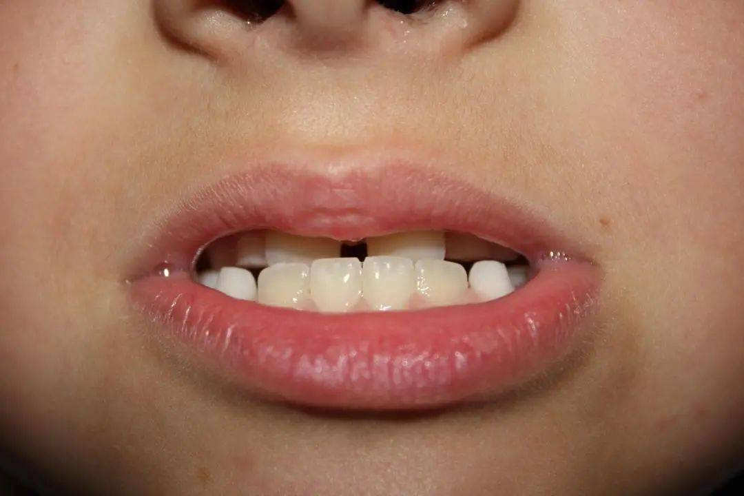 孩子_颌面_矫治