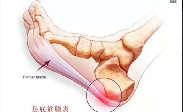 趾腱筋膜炎的位置图片图片