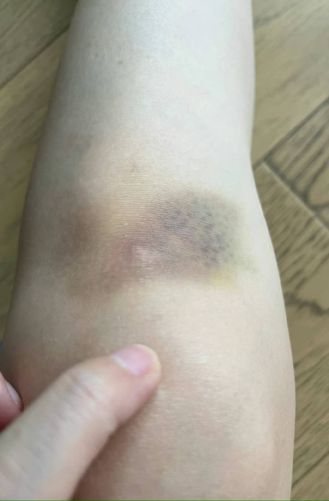 膝盖摔伤女孩子图片