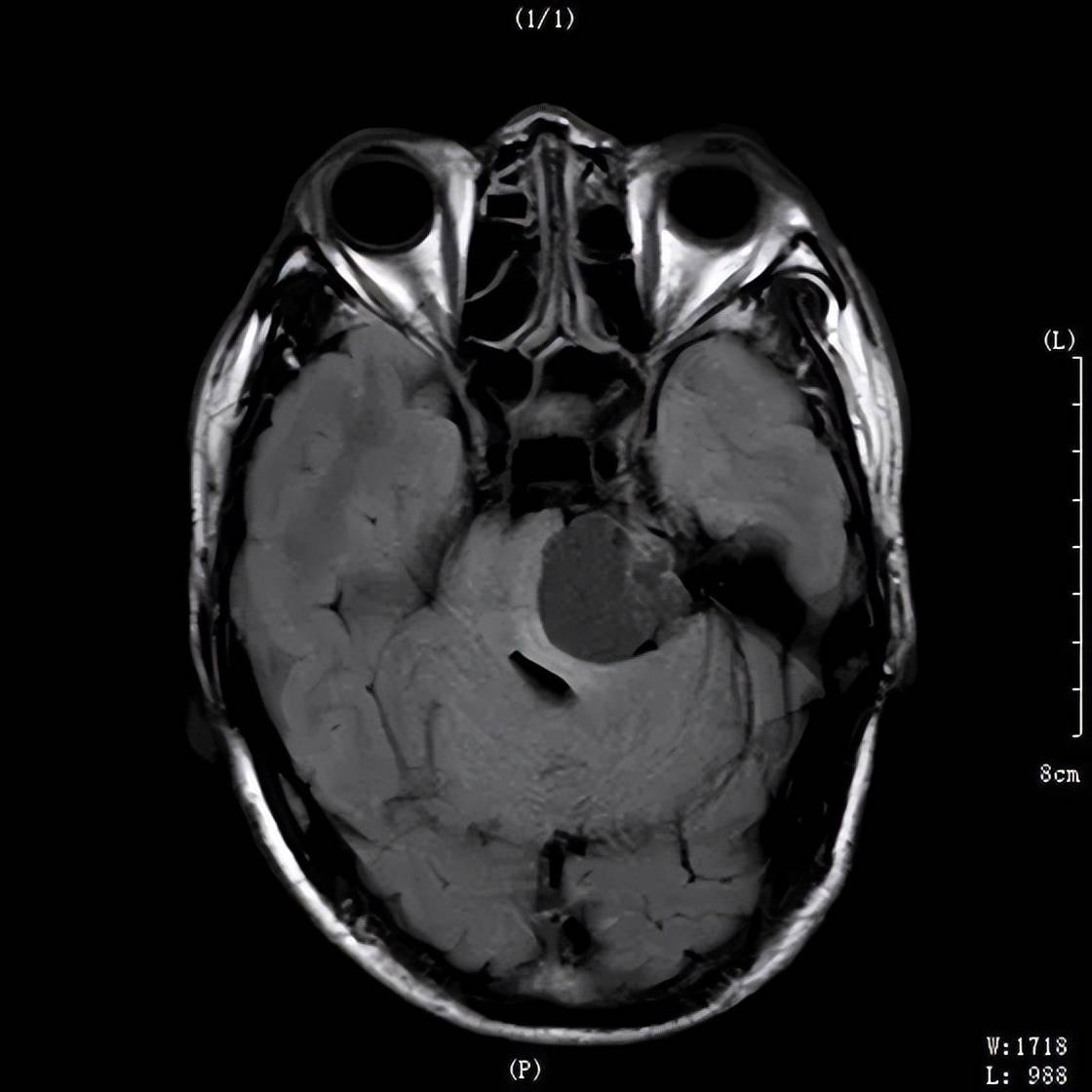 询问病史,查体及阅片后分析指示,目前诊断明确为:左侧桥小脑角占位性