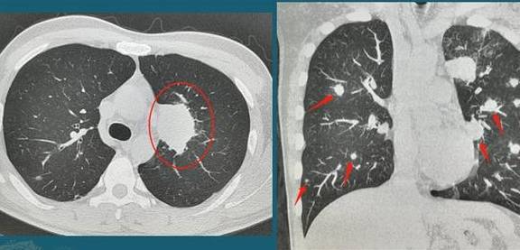 肺上有结节,5个细节判断有没有癌细胞入侵,医生帮你分析ct片_玻璃