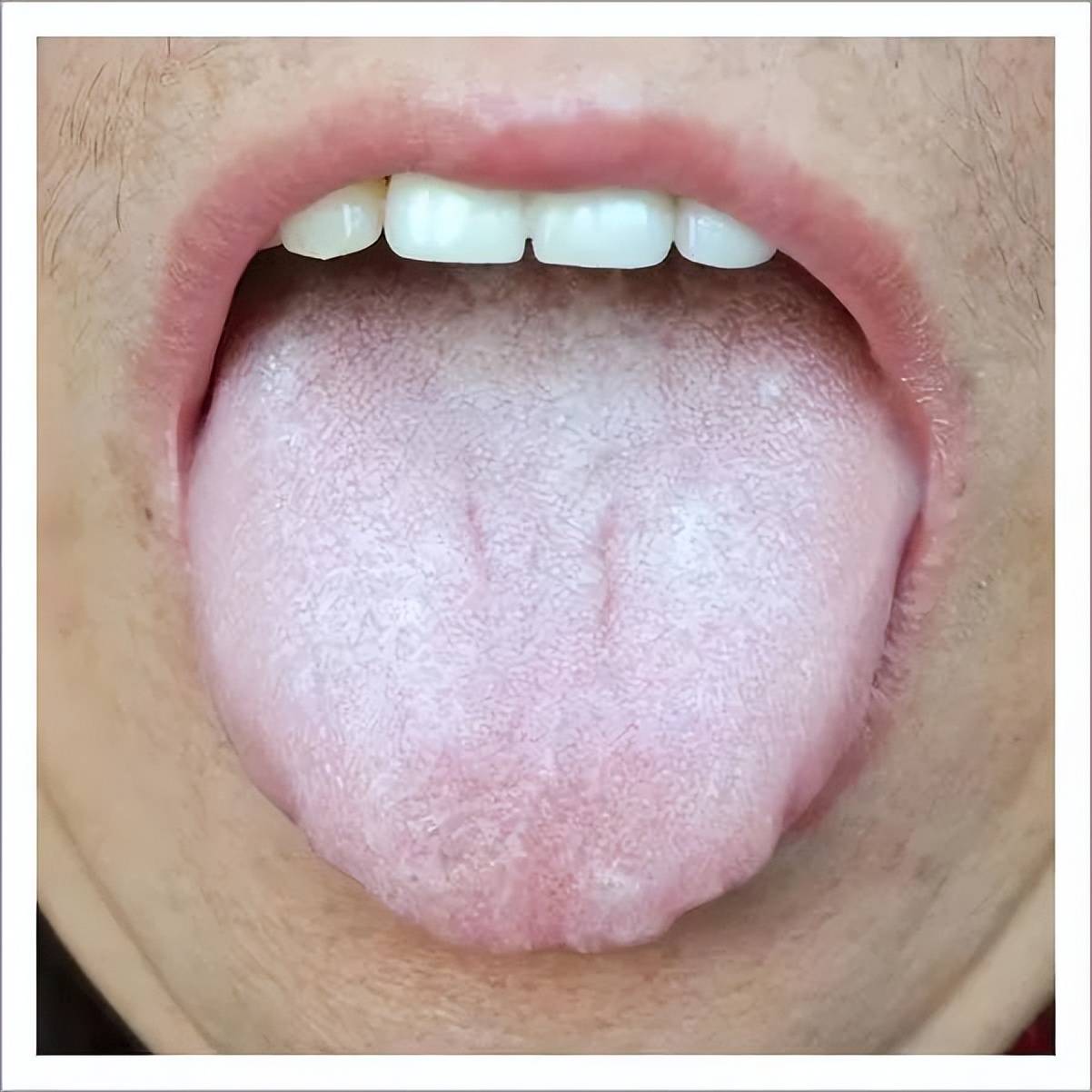 看舌辨健康:舌头越好看,人就越健康,舌头越难看,身体就越差劲