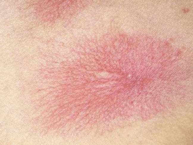 肝癌皮肤红斑图片图片