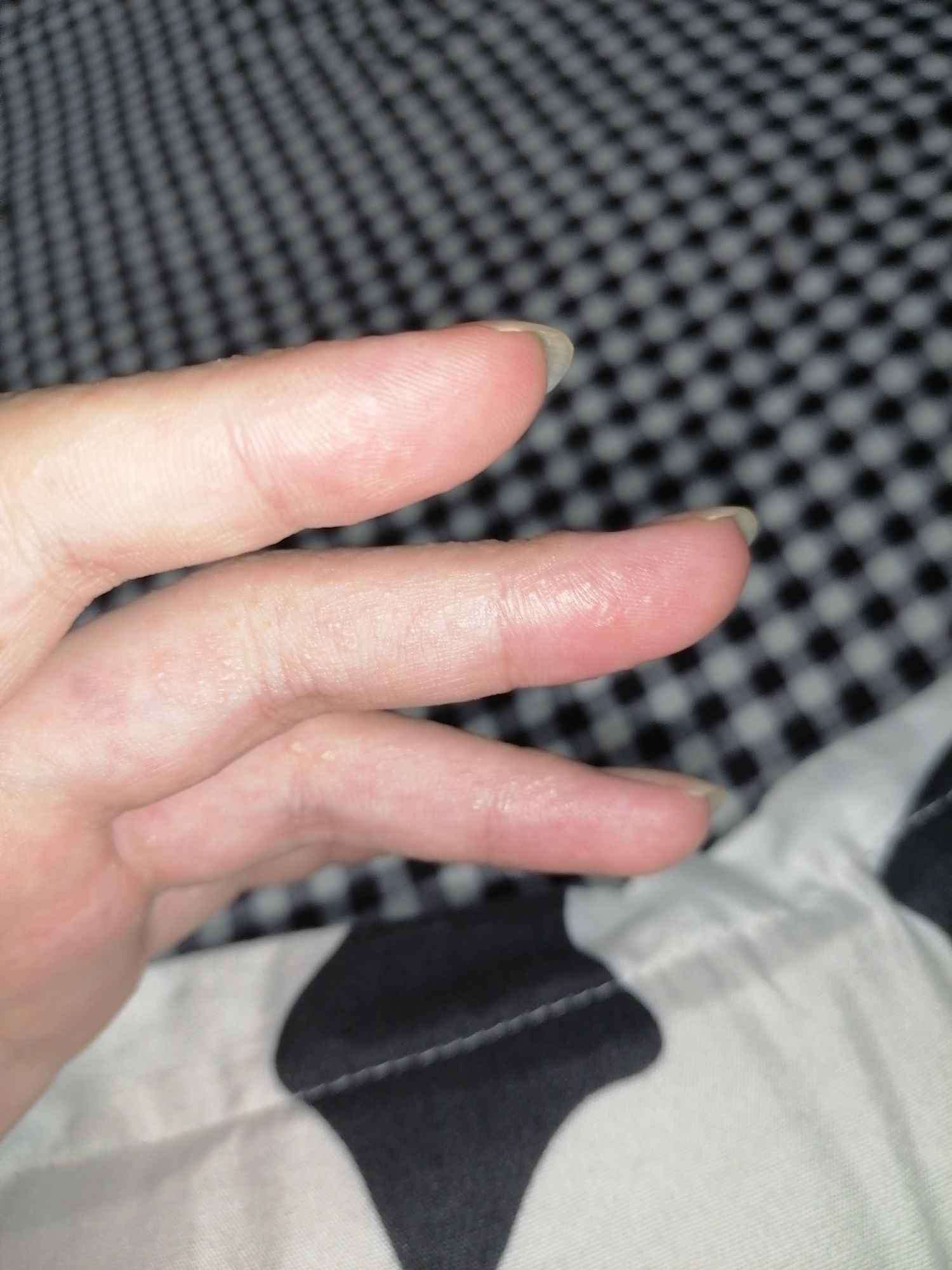 手上长小水泡是什么原因?越来越多,越来越痒_生活_皮肤_把手