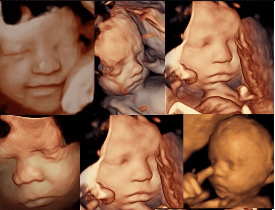 胎儿小下颌畸形图片
