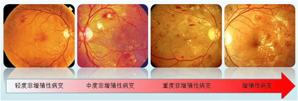 你知道么？糖尿病视网膜病变会失明——糖尿病眼病专病门诊开诊啦