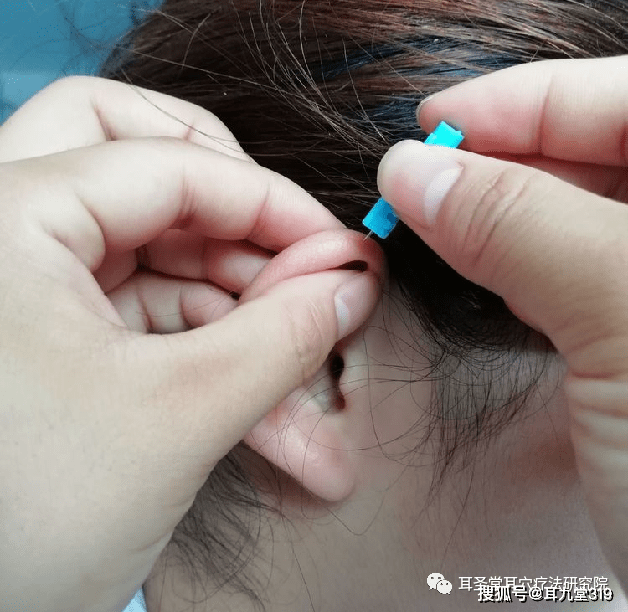 耳穴放血疗法好到怀疑人生耳穴疗法中医经络耳九堂养生保健