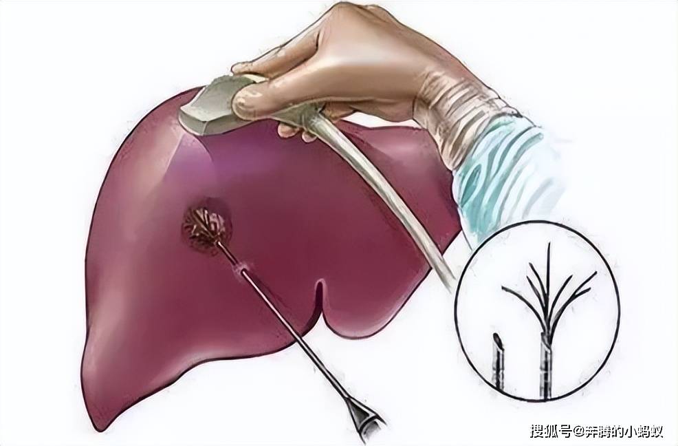 肝囊肿属常见病,超5cm需手术!_肝脏_患者_影响
