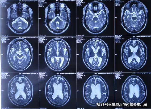 脑积水的头型图 头颅图片