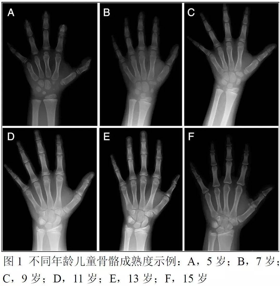 来源:《骨龄:儿科医生的简便工具》特别提醒家长注意的是:一定要抓住