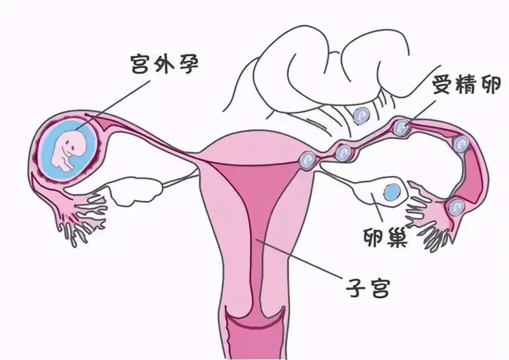 「湖南不孕症医院」37岁输卵管堵塞6年,经湘仁专家治疗好孕