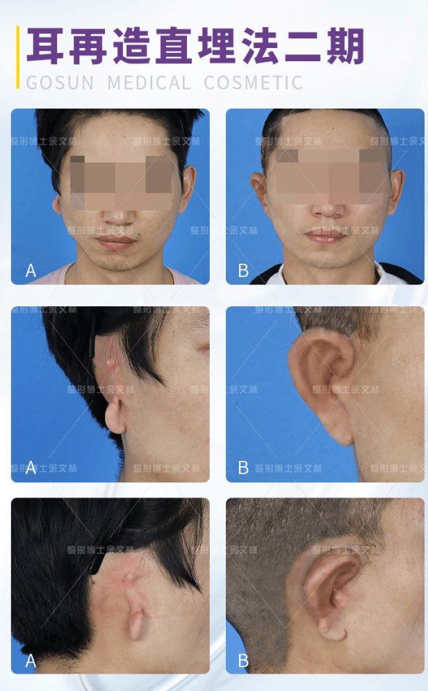 耳再造手术后对生活有什么影响_耳再造小耳畸形_小耳再造