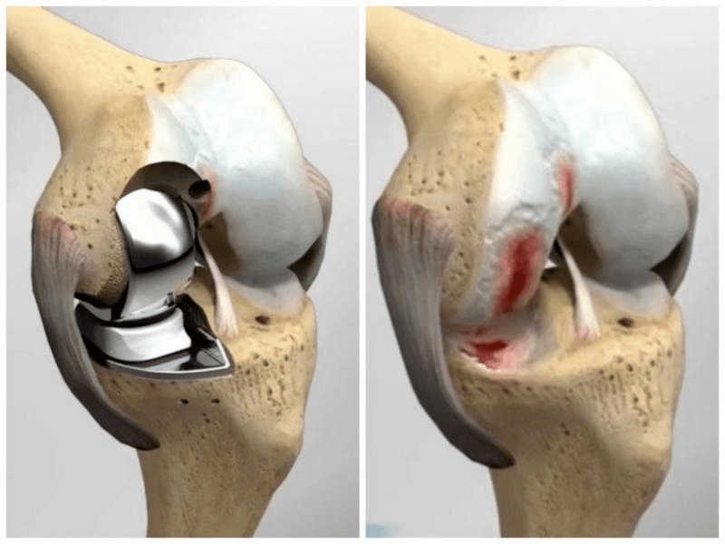 河南省直三院帮扶纪实首例膝关节微创单髁置换术在正阳成功开展