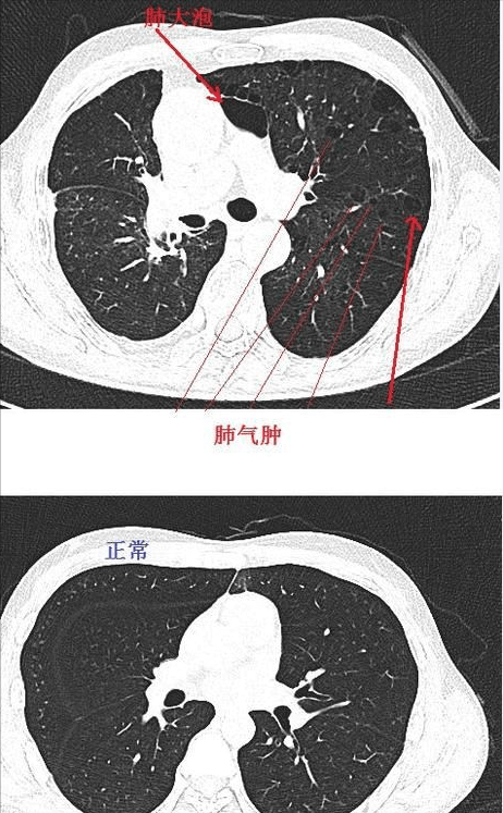 中醫治肺氣腫1例54歲肺氣腫6年真實案例分享