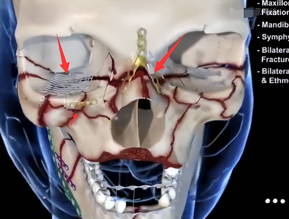 脸部3D重建，面部三维重建ct多少钱