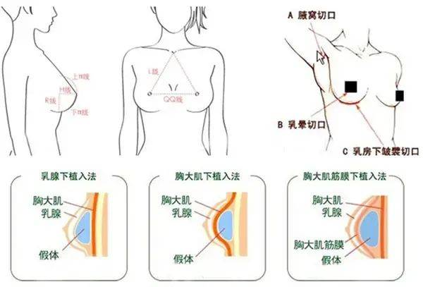 哺乳后做假体隆胸会不会影响下次哺乳?@美立方_乳房_手术_乳腺