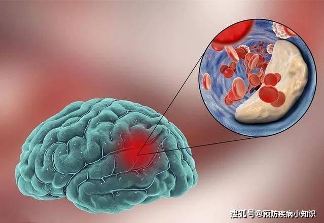 脑梗的根源被公布，肥肉排最后，看完榜首，赶紧忌口，忍住就是赢