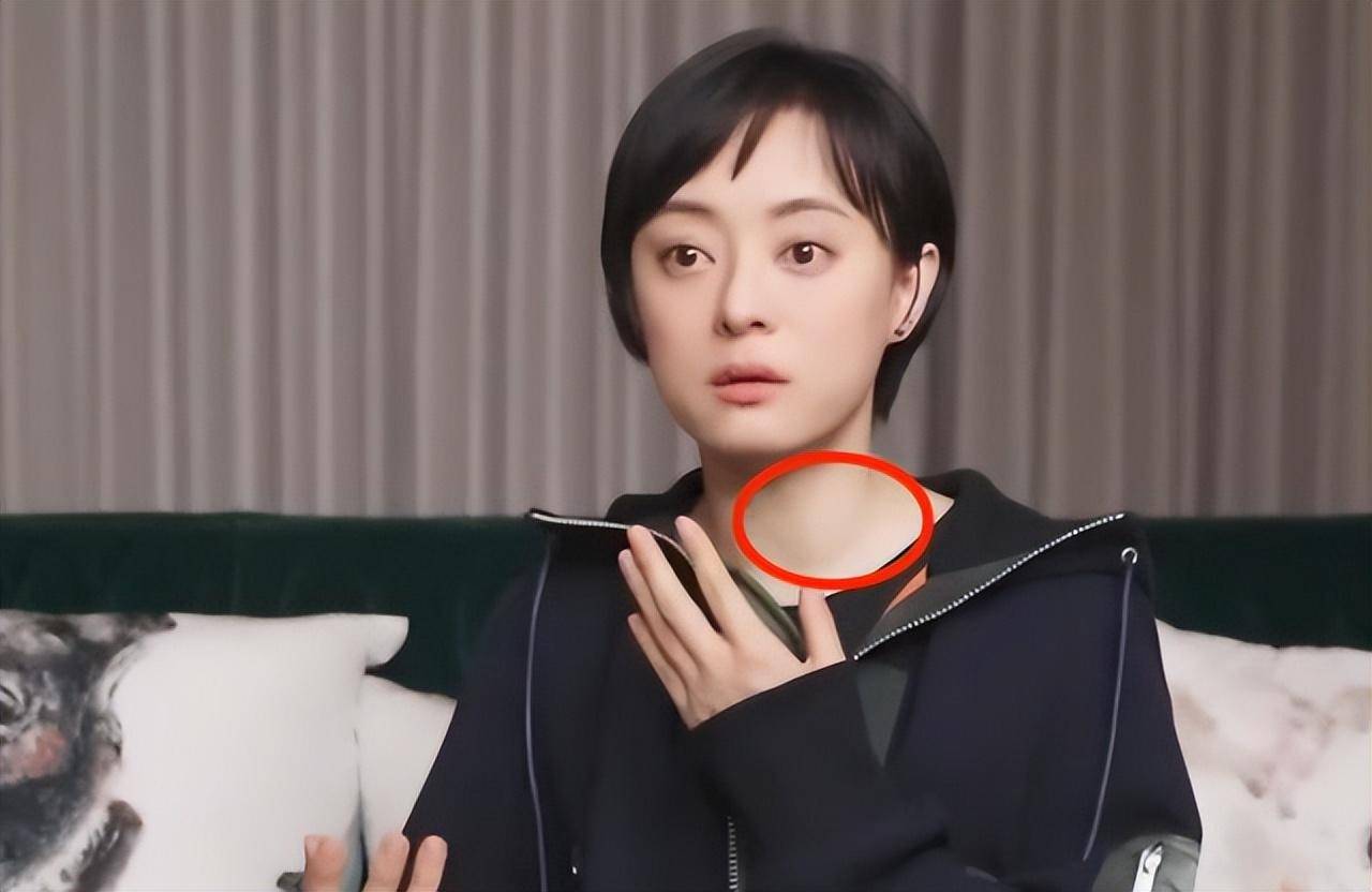 原创39岁孙俪近照引争议眼凸脖颈鼓包疑患甲亢无效养生被指像青蛙