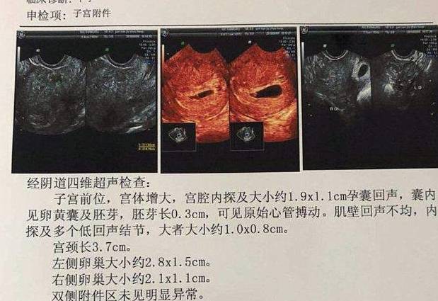 宫内早孕检查报告图片图片