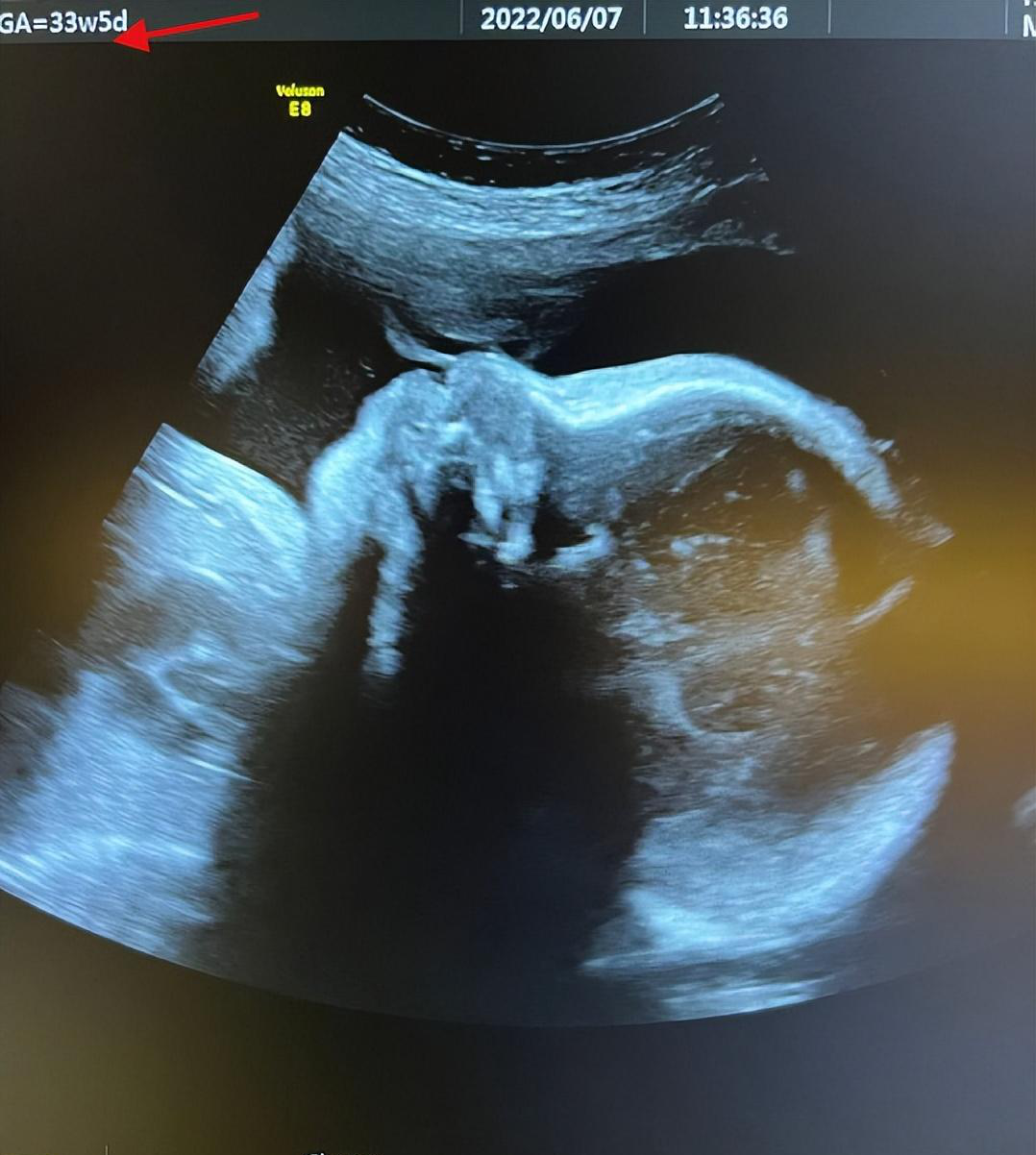 5个月男宝宝睾丸图片图片