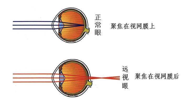近视远视散光是什么概念呢