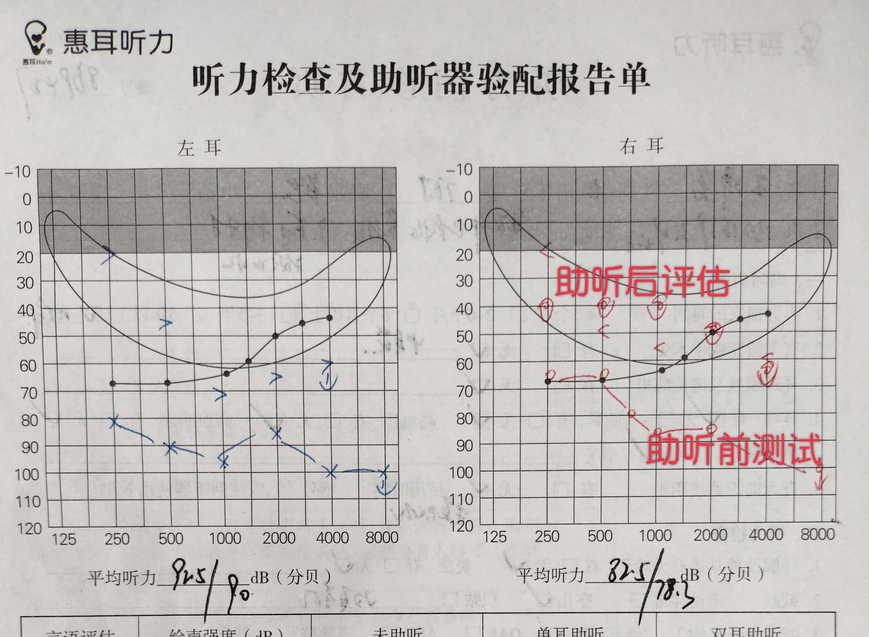 听力检查报告正常图片图片