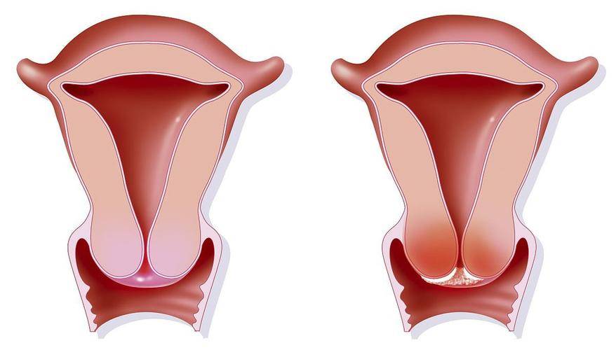 宫颈癌出血图片接触性图片