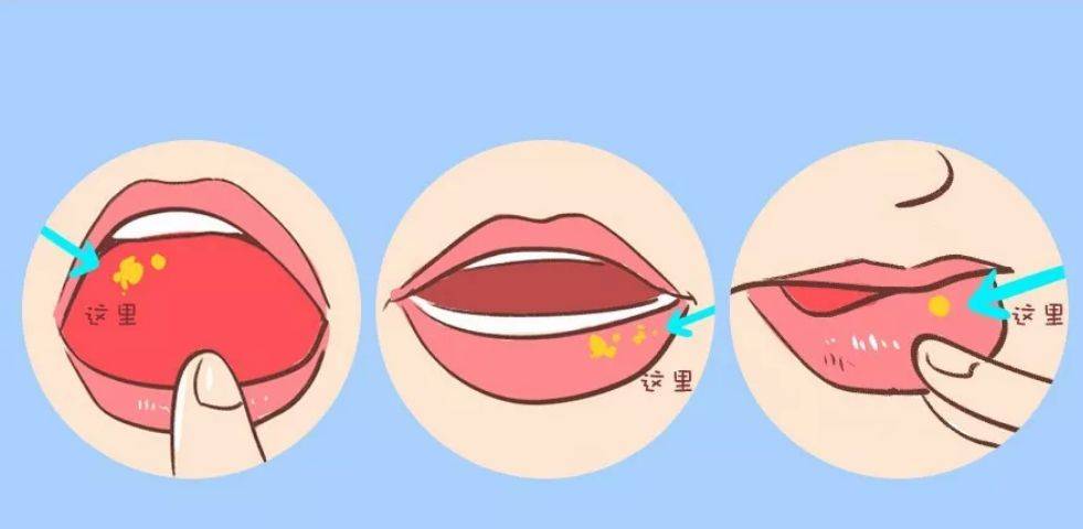 腺周口疮疤痕图片图片