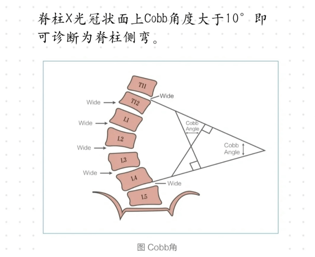 脊柱侧弯cobb角分级图片