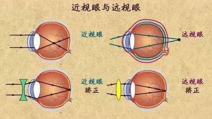 远视眼是怎么回事图片