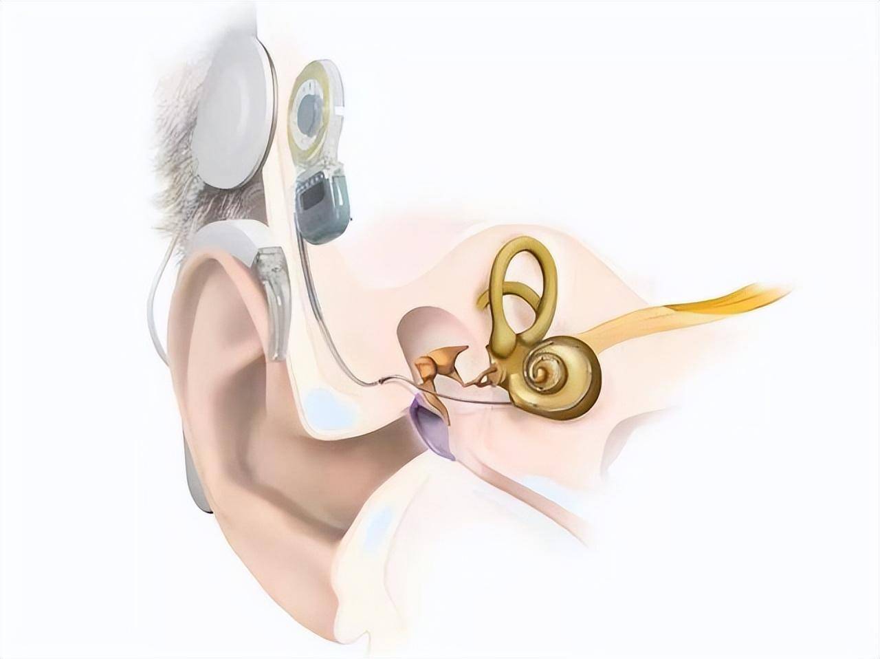 佩带助听器无效或效果不佳的大前庭患者,需要进行人工耳蜗植入
