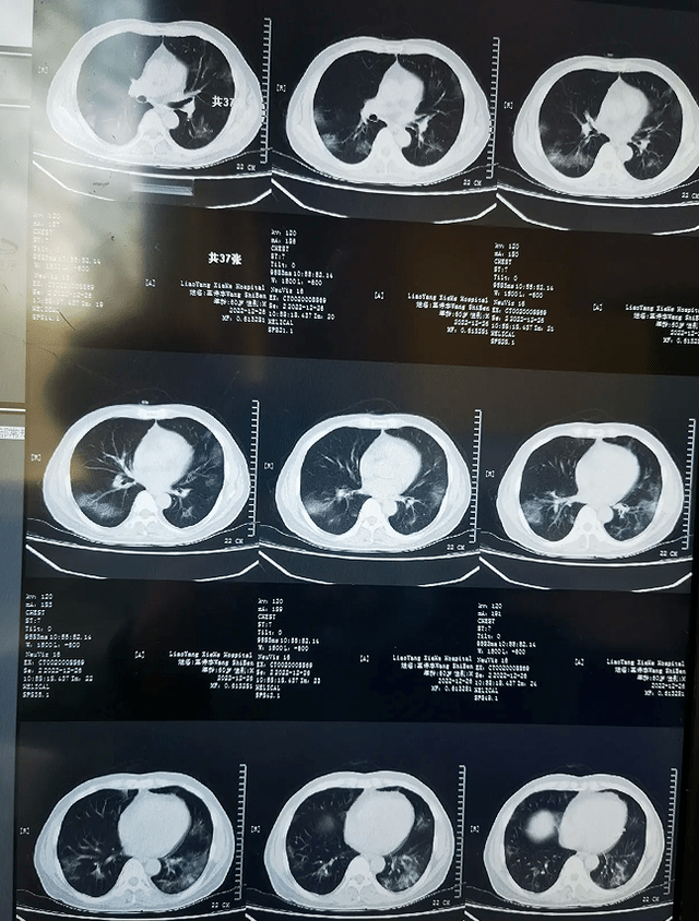 专家指出,重症的白肺患者,死亡率在40%以上,还是有一部分人是可以治愈